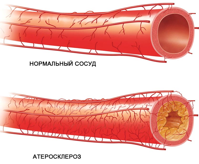 Болят икры ног, что делать?4