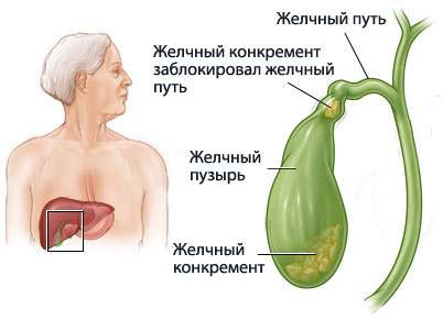 Заболевания желчного пузыря: симптомы, лечение4