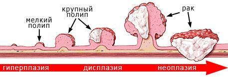 Полип в желчном пузыре: симптомы, лечение, что делать?4