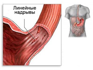 Печеночная недостаточность: острая, хроническая, симптомы, лечение4