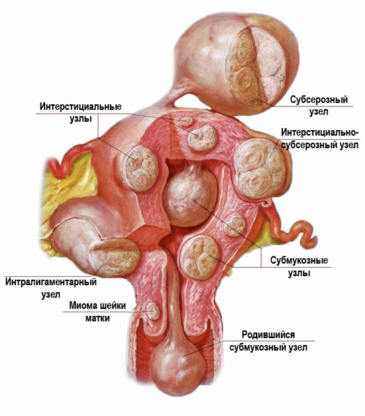 Миома матки: симптомы, лечение, операция4