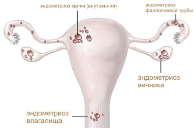 Аборт: виды абортов, осложнения после аборта4