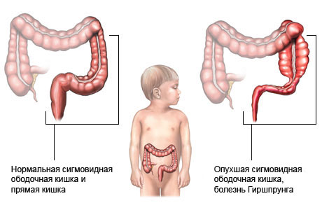 Болезнь Чагаса (Шагаса): симптомы, лечение4