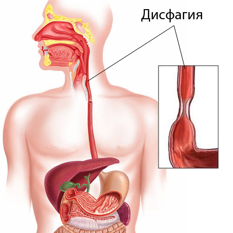 Грыжи пищевода: симптомы, лечение, диагностика, операция, фото4