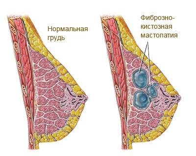 Почему болит грудь после овуляции?4