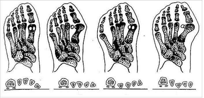 Болит косточка на пальце ноги, что делать?4