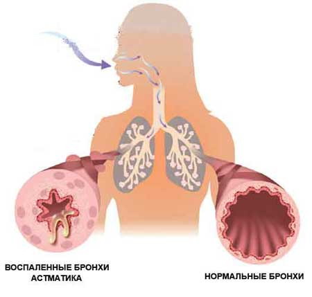 Профессиональные нейротоксикозы: диагностика, симптоматика, лечение4
