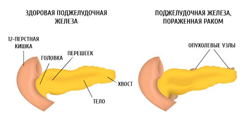Рак поджелудочной железы: симптомы, проявления, лечение4