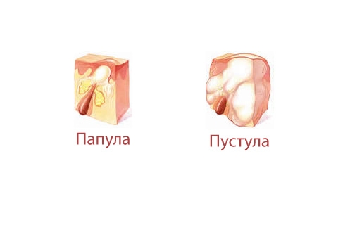 Эпидермофития кисти, стопы: симптомы, диагностика, лечение, фото4
