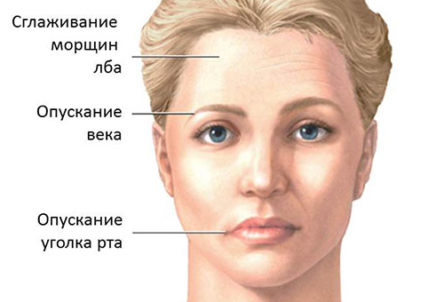 Почесуха Гебры: симптомы, диагностика, лечение, фото4