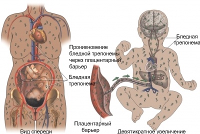 Врожденный сифилис: признаки, проявления. Сифилис плода4