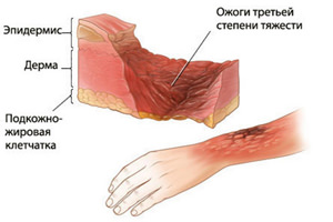Артифициальный дерматит: симптомы, диагностика, лечение, фото4