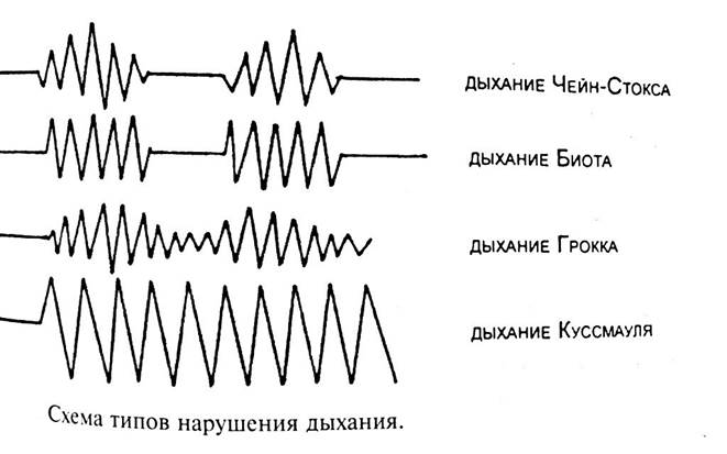 Коматозные состояния у детей. Неотложная помощь4
