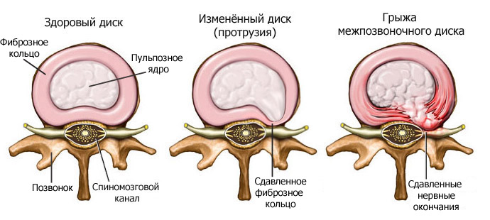 Почему болят мышцы ягодиц: причины, последствия, фото4