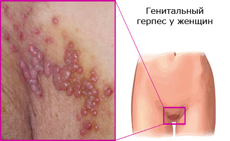 Генитальный герпес у мужчин и женщин: симптомы, лечение4