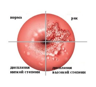 Дисплазия шейки матки: причины, степени, лечение4