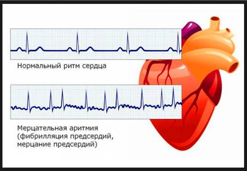 Последствия мерцательной аритмии: рекомендации врачей, лечение4
