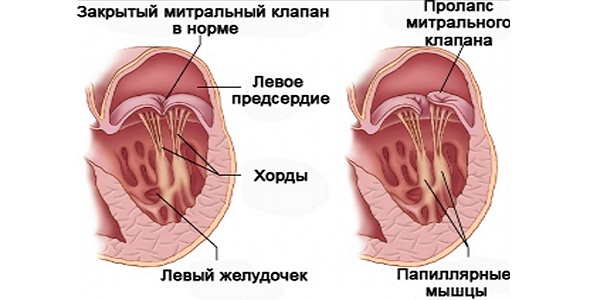 Врожденная недостаточность митрального клапана4