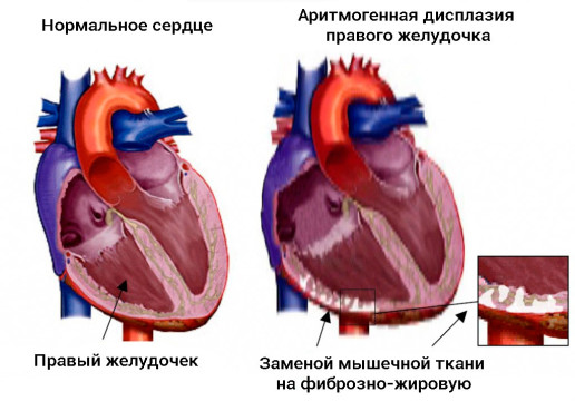 Желудочковые нарушения ритма 4