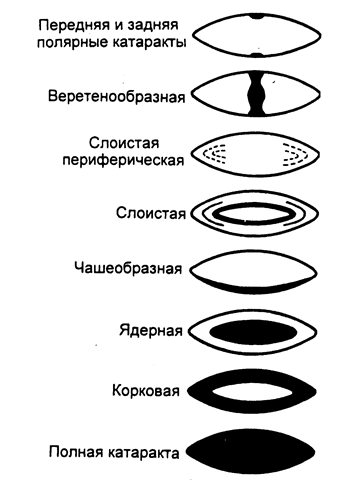 Катаракта глаз: симптомы, лечение, причины, операции, профилактика5