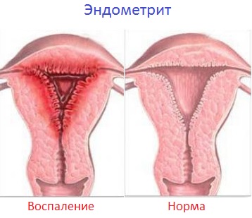 Жжение и боль при мочеиспускании у женщин и мужчин, лечение5