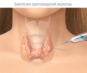 Киста щитовидной железы: лечение, правой и левой доли, фото, видео5