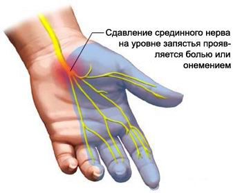 Болят кисти рук, что делать?5