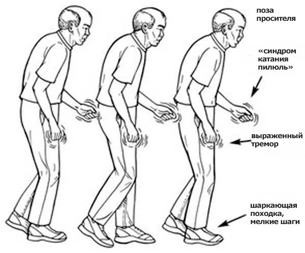 Цирроз печени: симптомы, лечение, стадии5