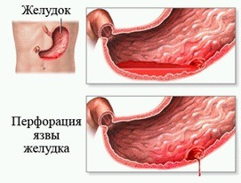 Язва желудка: симптомы, лечение, народные средства5