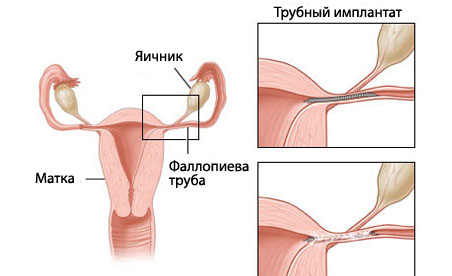 Бесплодие у женщин: причины и лечение бесплодия5