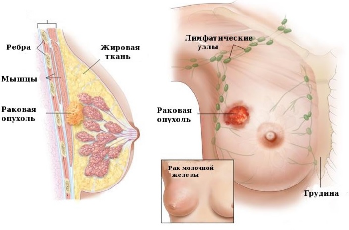 Миома матки: симптомы, лечение, операция5