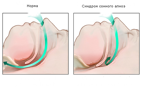 Почему после сна болит голова?5