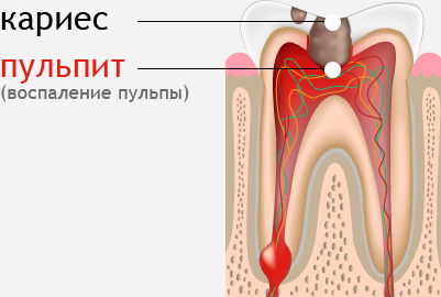Зуб мудрости болит, что делать?5