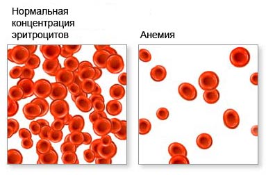 Интоксикация бензолом: симптомы, диагностика, лечение5