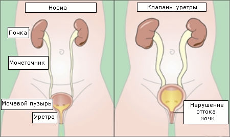 Острый гонорейный уретрит5