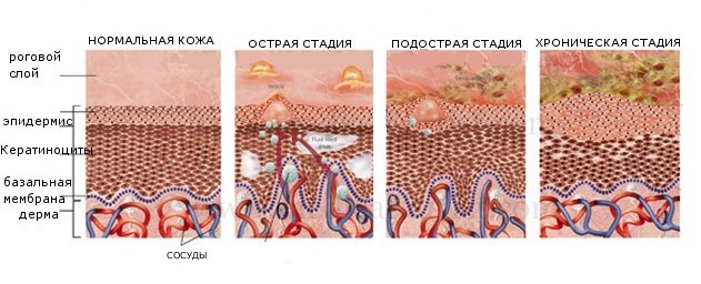 Эпидермофития кисти, стопы: симптомы, диагностика, лечение, фото5