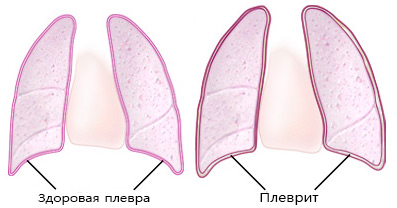 Почему болят мышцы плеча: диагностика, лечение, фото5