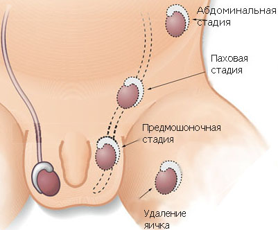 Гормоны яичка. Патологические состояния детей с недостаточностью гормона яичек5