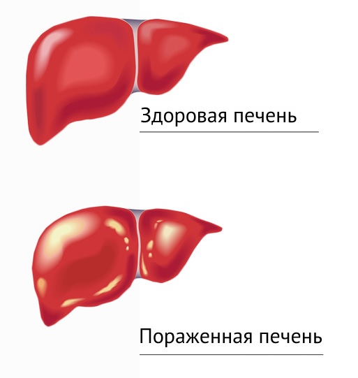 Коматозные состояния у детей. Неотложная помощь5