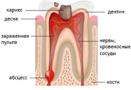 Лечение временных зубов. Некроз пульпы 5