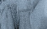 Перелом корня зуба