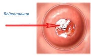 Лейкоплакия шейки матки: симптомы, лечение5