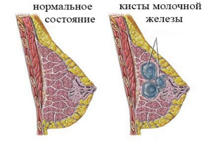 Боль в молочной железе: причины, симптомы, лечение5