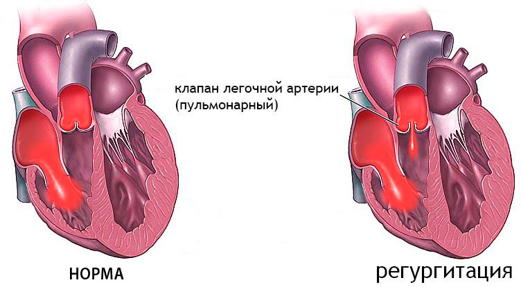Тетрада Фалло: прогноз после операции, рекомендации врачей5