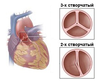 Подклапанный стеноз аорты5