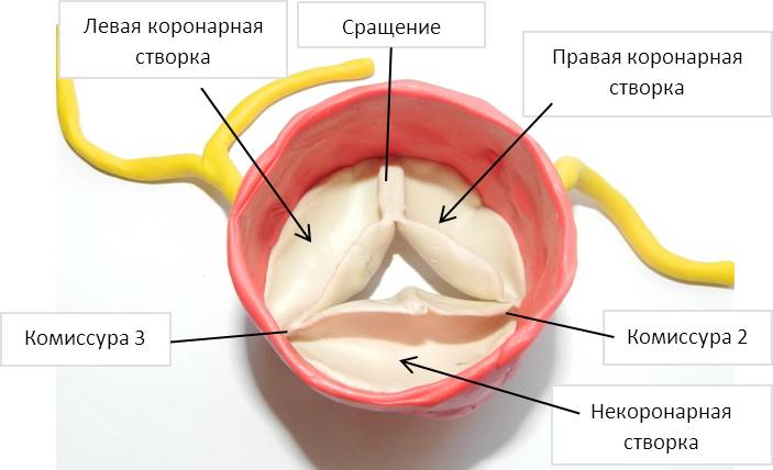 Корригированная транспозиция магистральных артерий 5