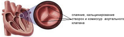 Операция на митральном клапане сердца5
