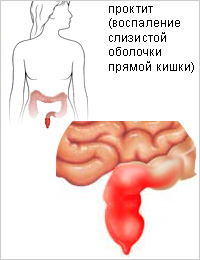 Колит кишечника: симптомы, лечение у взрослых6