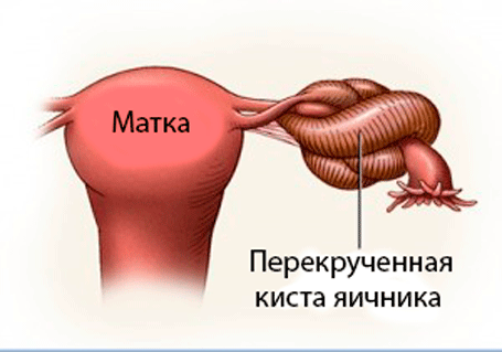 Что делать, если болит низ живота?6