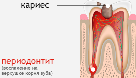 Зуб мудрости болит, что делать?6